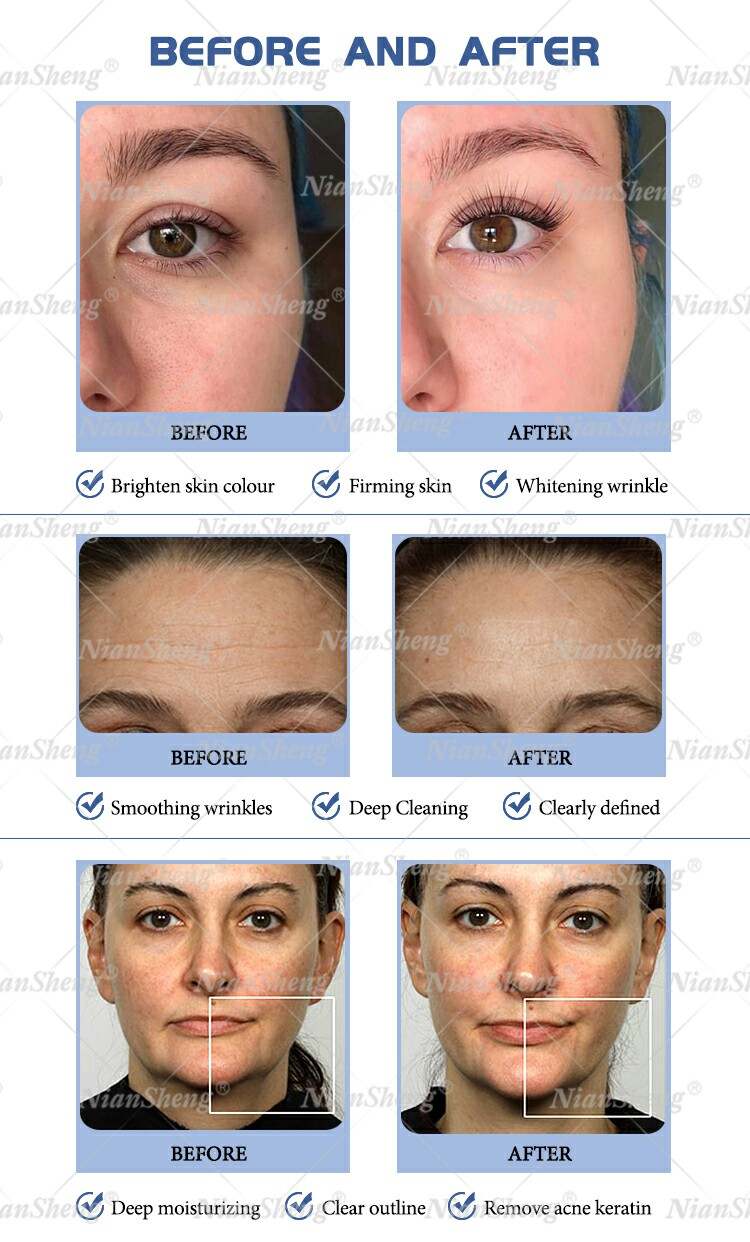 Hydra Microdermabrasion Skin Care BIO Ultrasonic Face Massage Jet Peel Deep Cleaning Beauty Machine