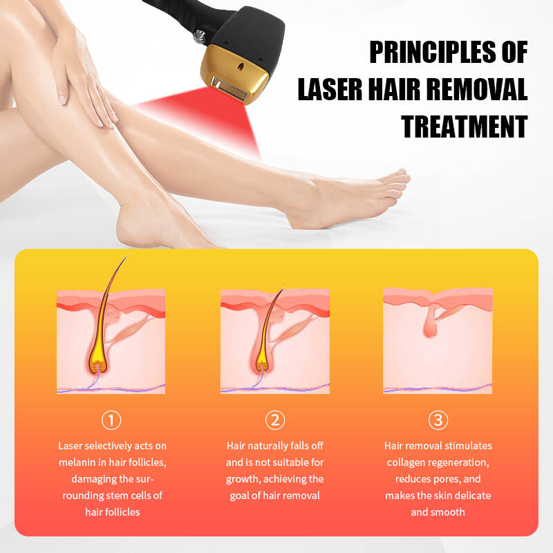 Alexandrite hair removal machine;soprano ice platinum diode laser; remove hair effect