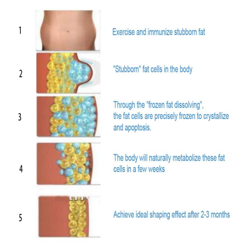 advantages of cryolipo slimming machines