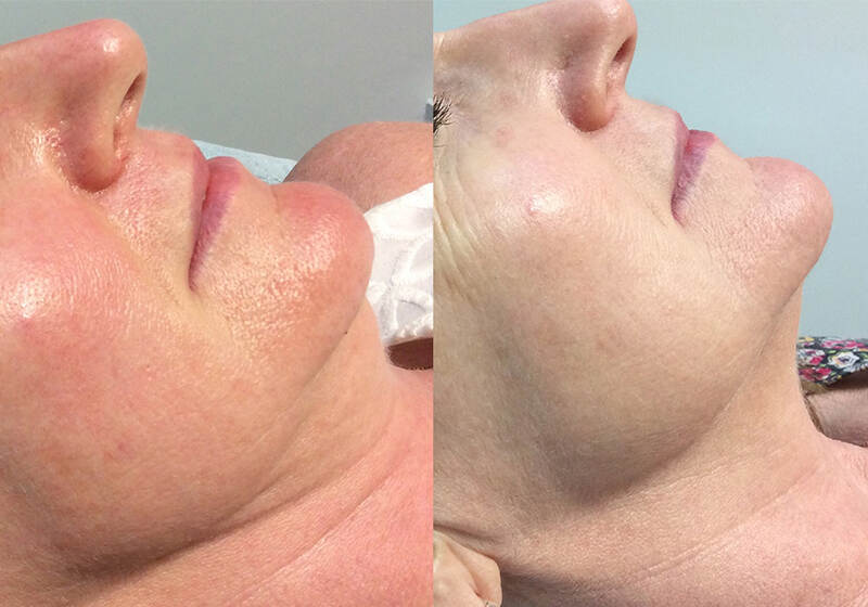 Werk Laser Genesis vir plooie?