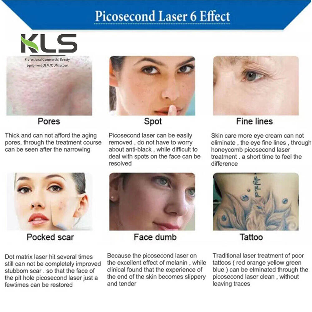 Produkte për kujdesin personal të bukurisë, makineria për heqjen e tatuave 1064 532 755 picosecond lazer nd yag, makina spa makina bukurie makina bukurie sallon pajisje shtëpie për kujdesin personal pajisje bukurie, produkte të kujdesit personal portativ 1064 532 755 picosecond lazer nd yag për rinovim të lëkurës, bukuri të tjera produkte personale të kujdesit personal personal