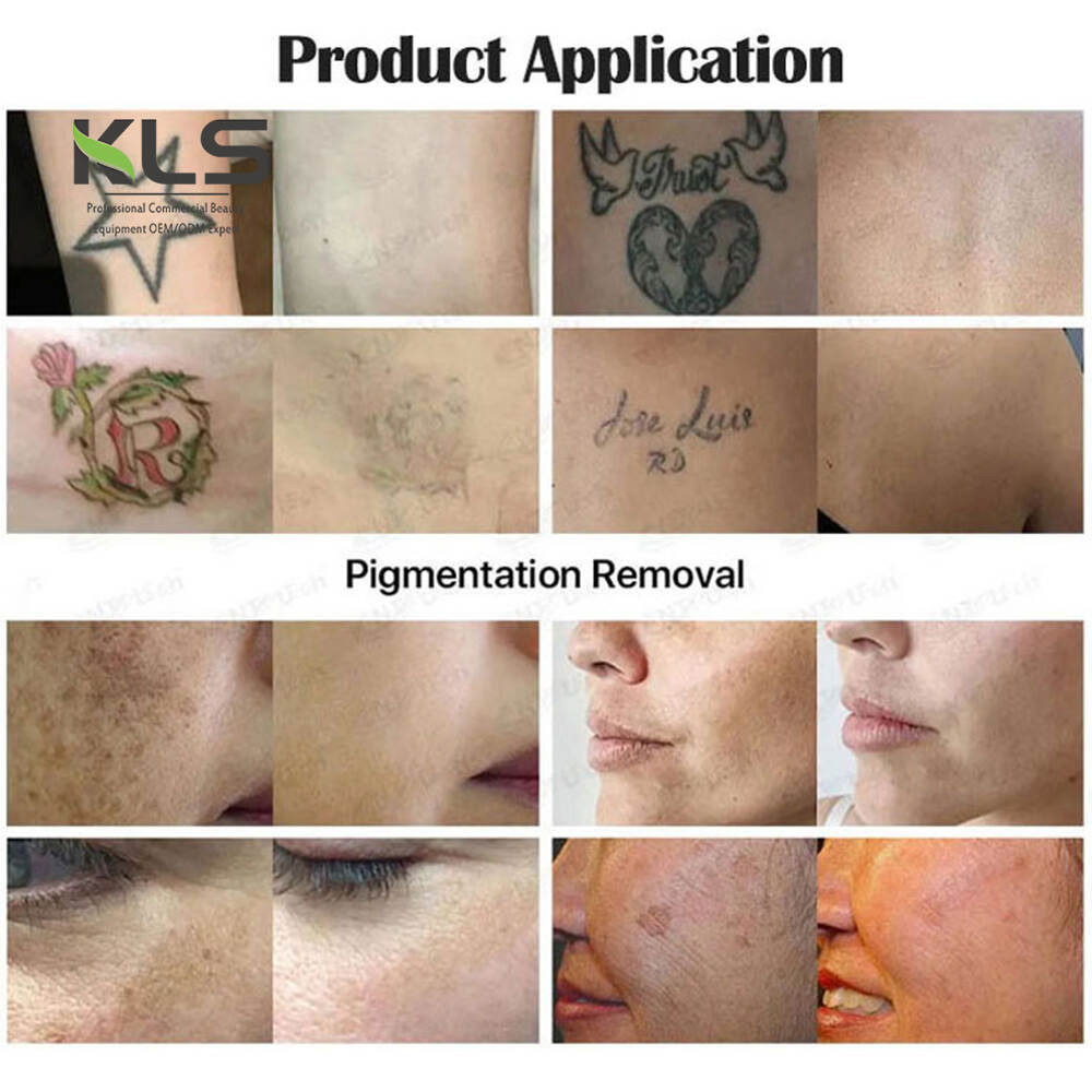 Produkte për kujdesin personal të bukurisë, makineria për heqjen e tatuave 1064 532 755 picosecond lazer nd yag, makina spa makina bukurie makina bukurie sallon pajisje shtëpie për kujdesin personal pajisje bukurie, produkte të kujdesit personal portativ 1064 532 755 picosecond lazer nd yag për rinovim të lëkurës, bukuri të tjera produkte personale të kujdesit personal personal