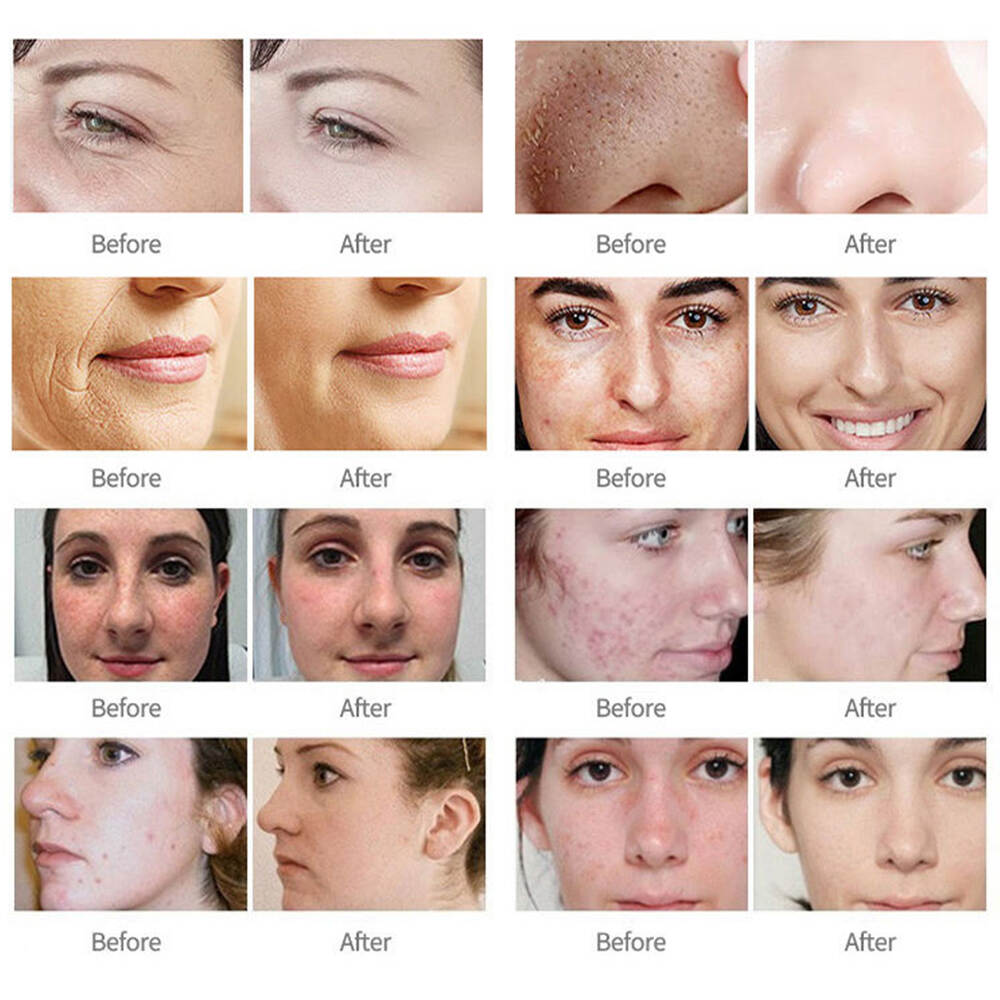 Thiết bị làm đẹp bằng Laser Máy Laser cầm tay Máy làm đẹp bằng laser Máy cắt và khắc laser co2 Máy Laser Co2 Laser Fractional Co2 Laser Galvo Co2 Co2 Máy Laser Fractional Máy Laser Co2 Fractional Máy Laser Co2 cầm tay 1325 Fractional Co2 Laser Hàn Quốc Loại bỏ sẹo phân đoạn Máy tái tạo bề mặt da Điều trị mụn trứng cá bằng Laser Co2 Fractional