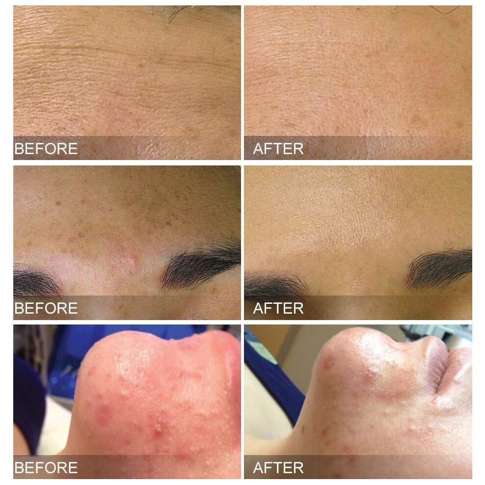 Μηχανή Dermabrasion του προσώπου. Υδρά κόκκινο φως προσώπου διαμάντια αποφλοιώνει τους πόρους του νερού φροντίδα δέρματος καθαρισμός Hydra Machine? Η μηχανή φλούδας οξυγόνου του δέρματος. Hydra Dermabrasion Spa Salon Χρησιμοποιήστε προϊόντα φροντίδας του δέρματος προσώπου