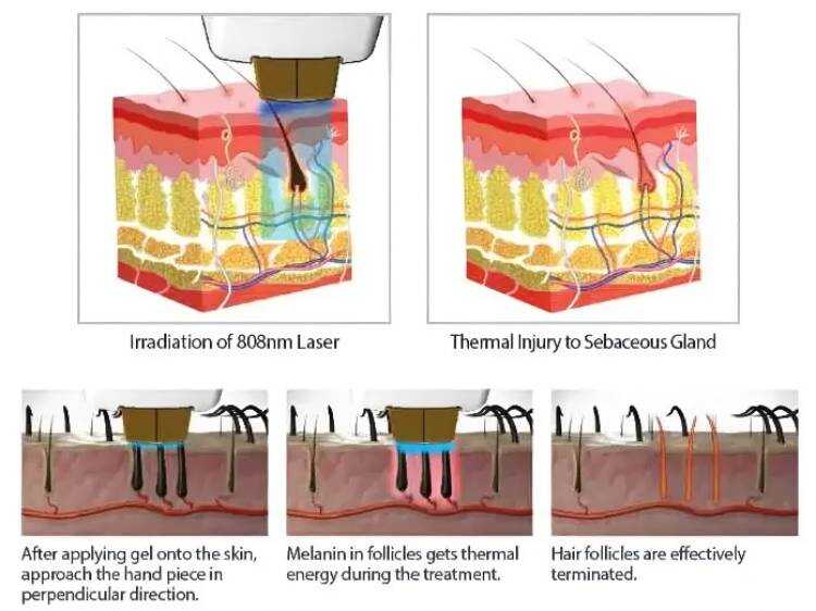 The working principle of Diode laser hair removal