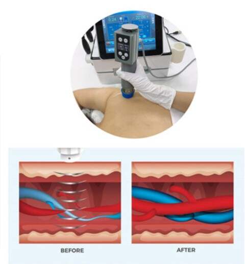 Working Principle of shockwave body slimming machine