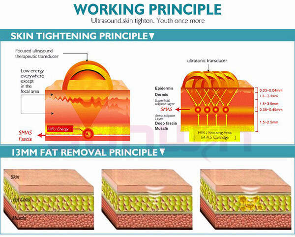 working principle of wholesale hifu in anti-wrinkle machine